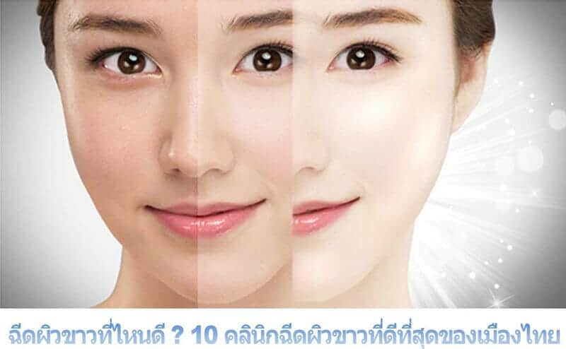 ฉีดผิวขาว ขอนแก่น