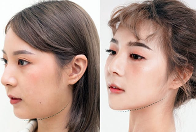 ฉีดโบท็อกซ์ ขอนแก่น