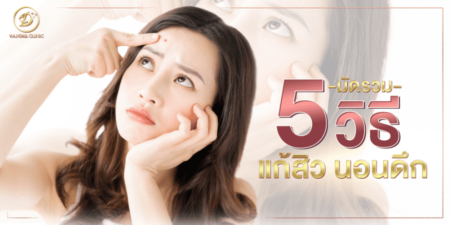 มัดรวม 5 วิธีแก้สิวนอนดึก