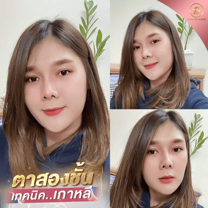 ตาสองชั้นแบบเกาหลี