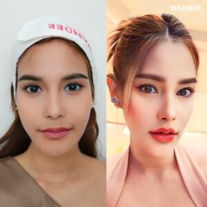 ฟิลเลอร์ปากอยู่ได้นานไหม
