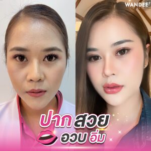 ฟิลเลอร์ปากอยู่ได้นานไหม