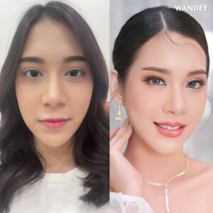 ฟิลเลอร์ปากอยู่ได้นานไหม