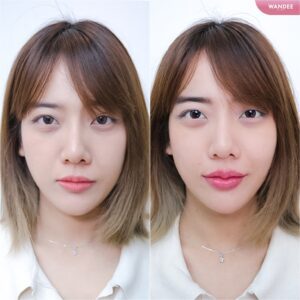 ฟิลเลอร์ปากอยู่ได้นานไหม