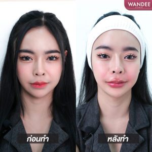ฟิลเลอร์ปากอยู่ได้นานไหม